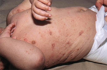 Avances en el tratamiento de escarbosis