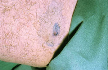 Avances en el tratamiento de las escarbosis