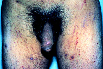 Avances en el tratamiento de la escarbosis