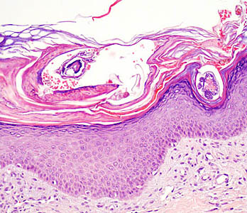 Avances en el tratamiento de la escarbosis